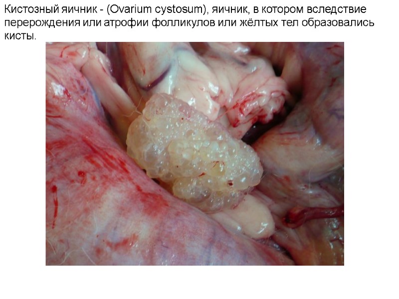 Кистозный яичник - (Ovarium cystosum), яичник, в котором вследствие перерождения или атрофии фолликулов или